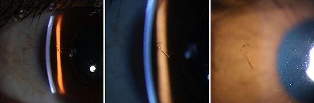 A man who went for a routine eye check-up was found to have a splinter lurking in his cornea ¿ and doctors say it had been there for 15 years. Pictured, the splinter on closer inspection