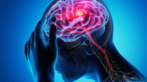 علاج جديد يقلل من وفيات السكتة الدماغية
