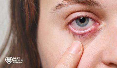 ما سبب وجود كيس ماء في بياض العين وما علاجه؟